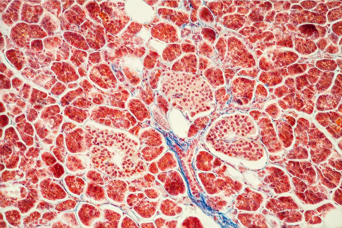 Así es el revolucionario fármaco para cáncer de páncreas que ya empieza a beneficiar al enfermo