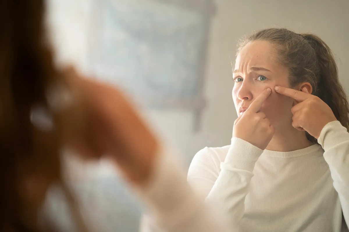 Epidemia de acné en la mujer adulta: cinco cambios en los hábitos de vida que pueden mejorarlo
