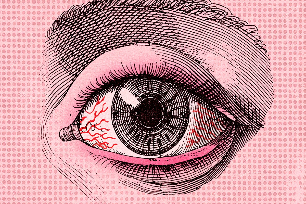 Ni manzanilla, ni otros remedios caseros para afrontar el lagrimeo y picor de ojos síntomas principales de las conjuntivitis