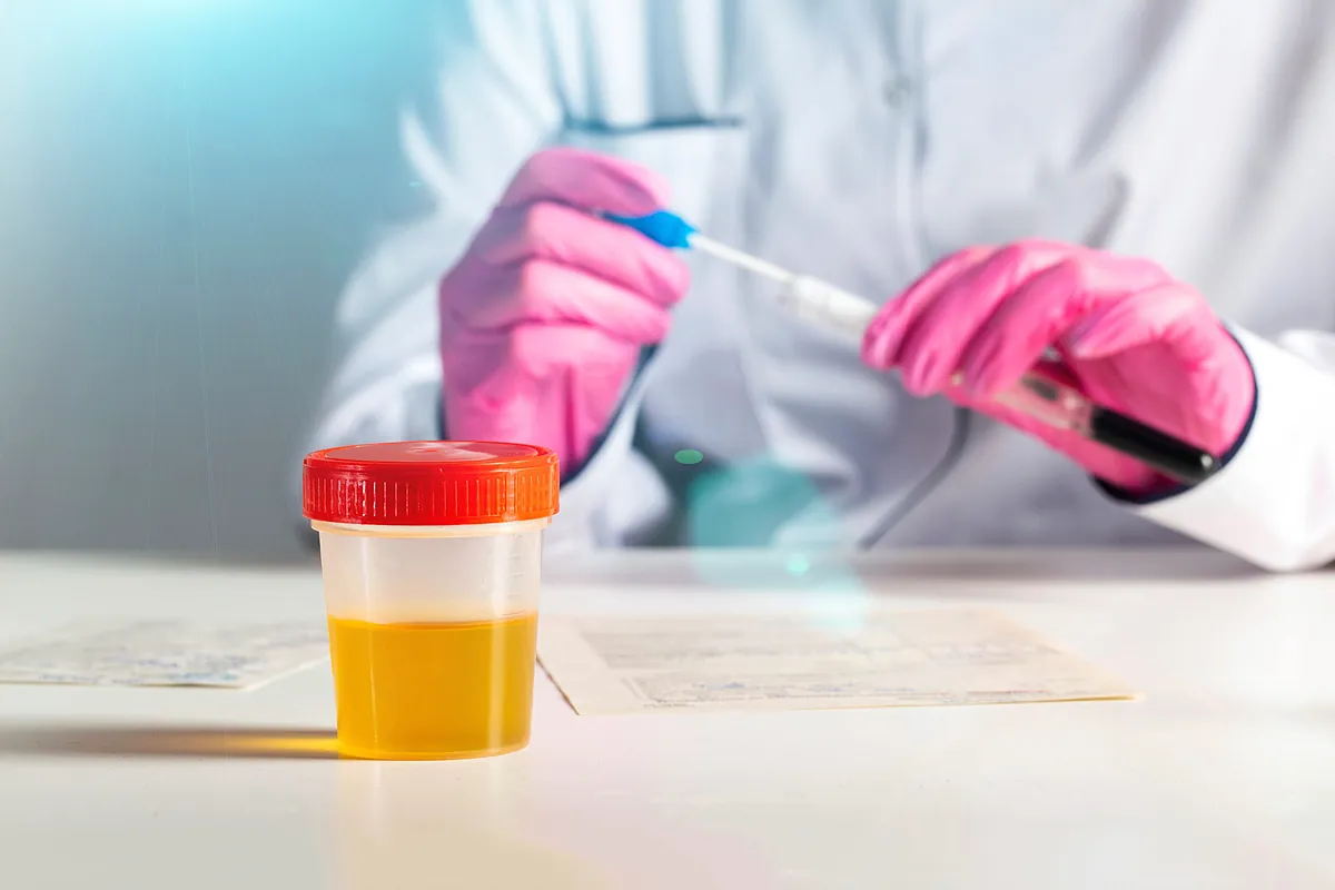 El daltonismo es un factor de peor pronóstico en el cáncer de vejiga