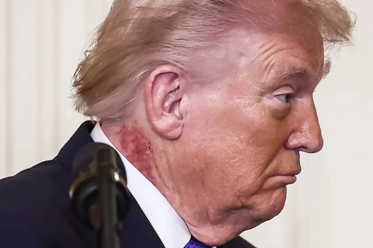 ¿Por qué Donald Trump tiene un sarpullido en el cuello? Saltan las dudas sobre su salud