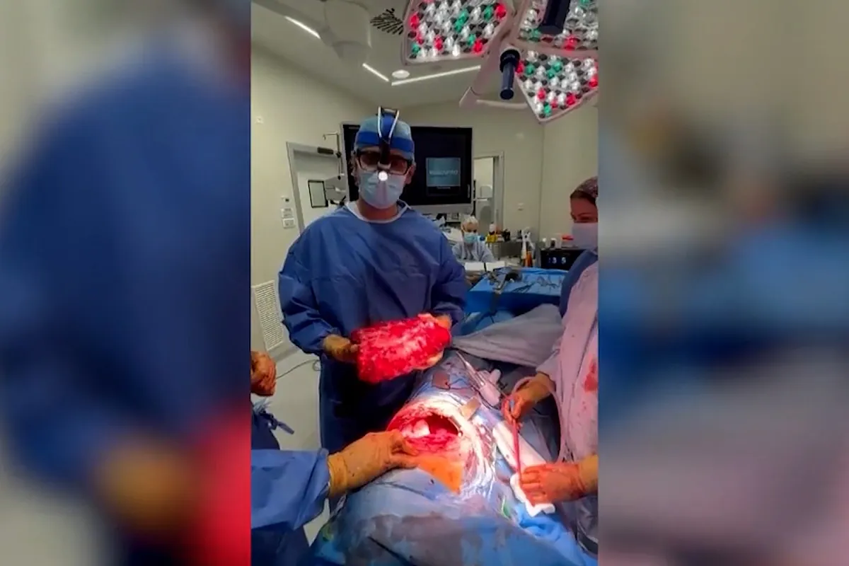 Extirpan un tumor de más de cuatro kilos a una paciente desahuciada y le salvan la vida